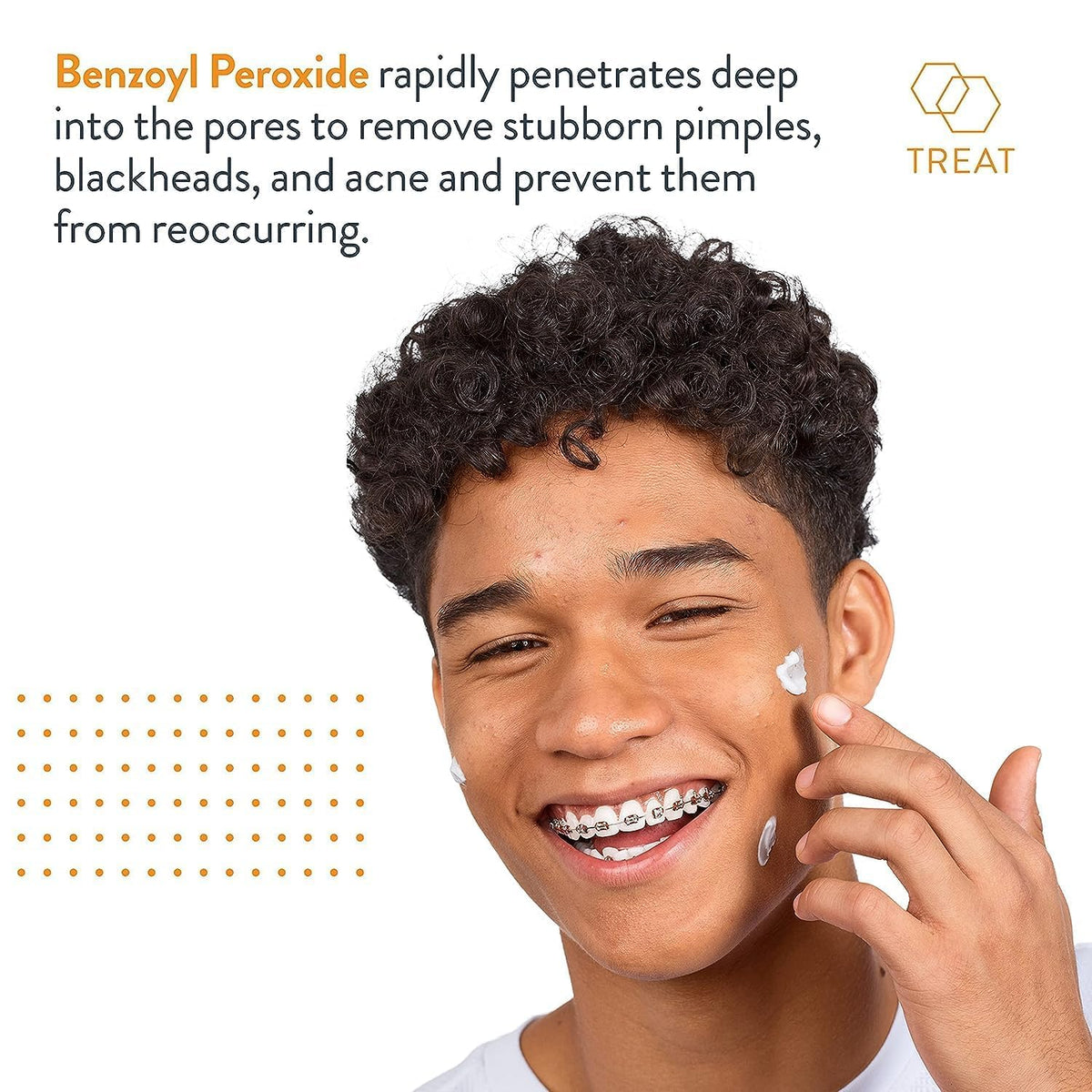 AcneFree Terminator 10 applied to blemish demonstrating targeted treatment