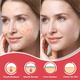 AcneGo close-up of thin hydrocolloid texture showing discreet coverage