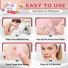 AcneGo patch under light makeup illustrating concealable spot coverage