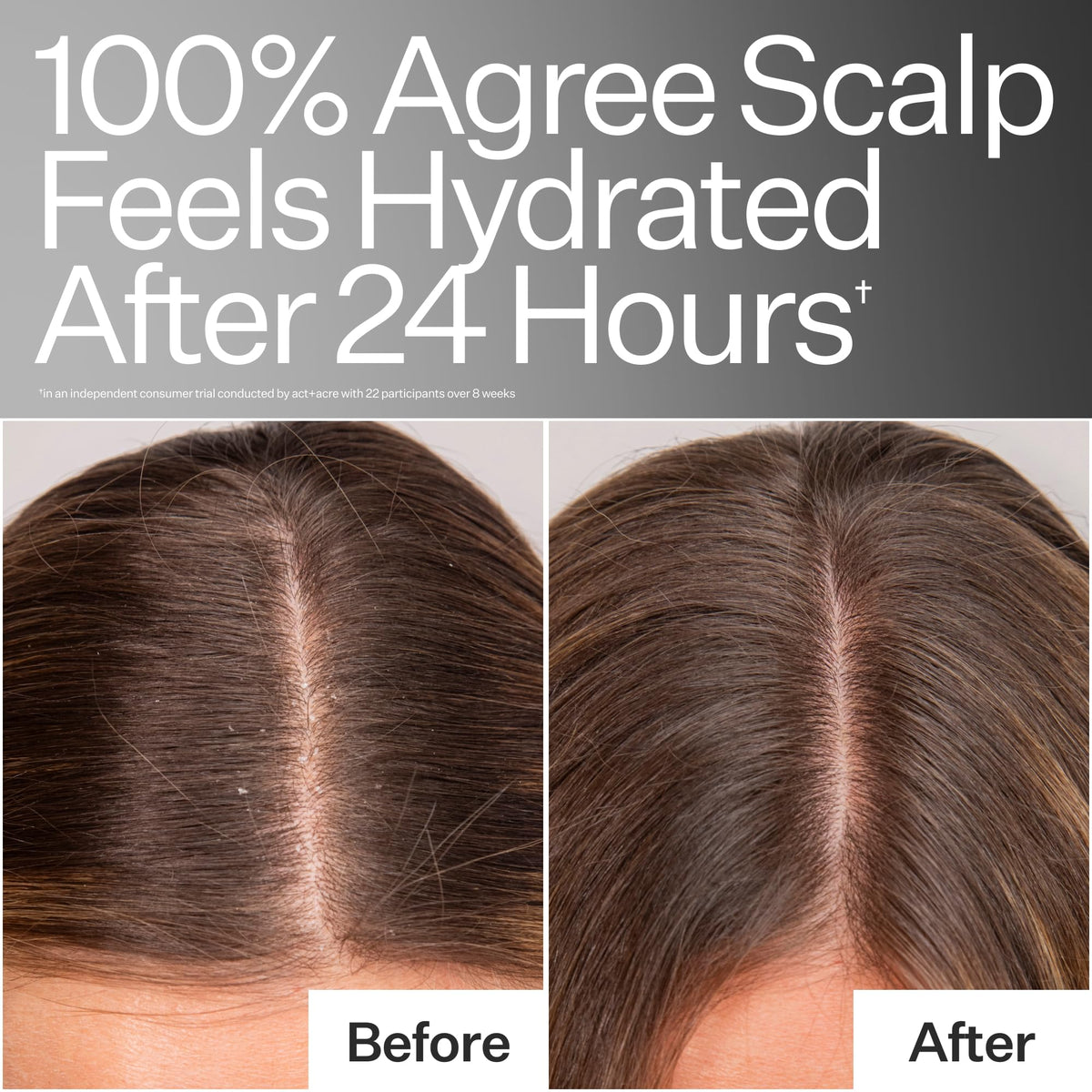 ACT+ ACRE before-and-after hydration graphic showing improved scalp comfort