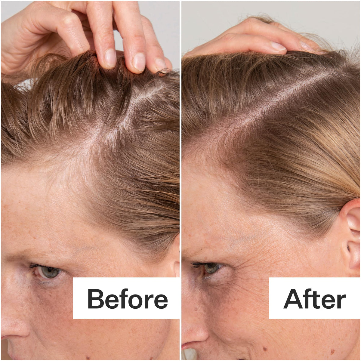 Act+ Acre applied to scalp demonstrating targeted application and relief
