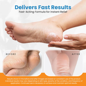 activelife Revitaderm 4D applied on heel demonstrating softened skin