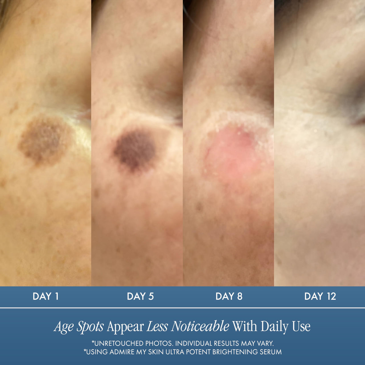 Admire My Skin label close-up revealing kojic, azelaic and Synovea HR benefits