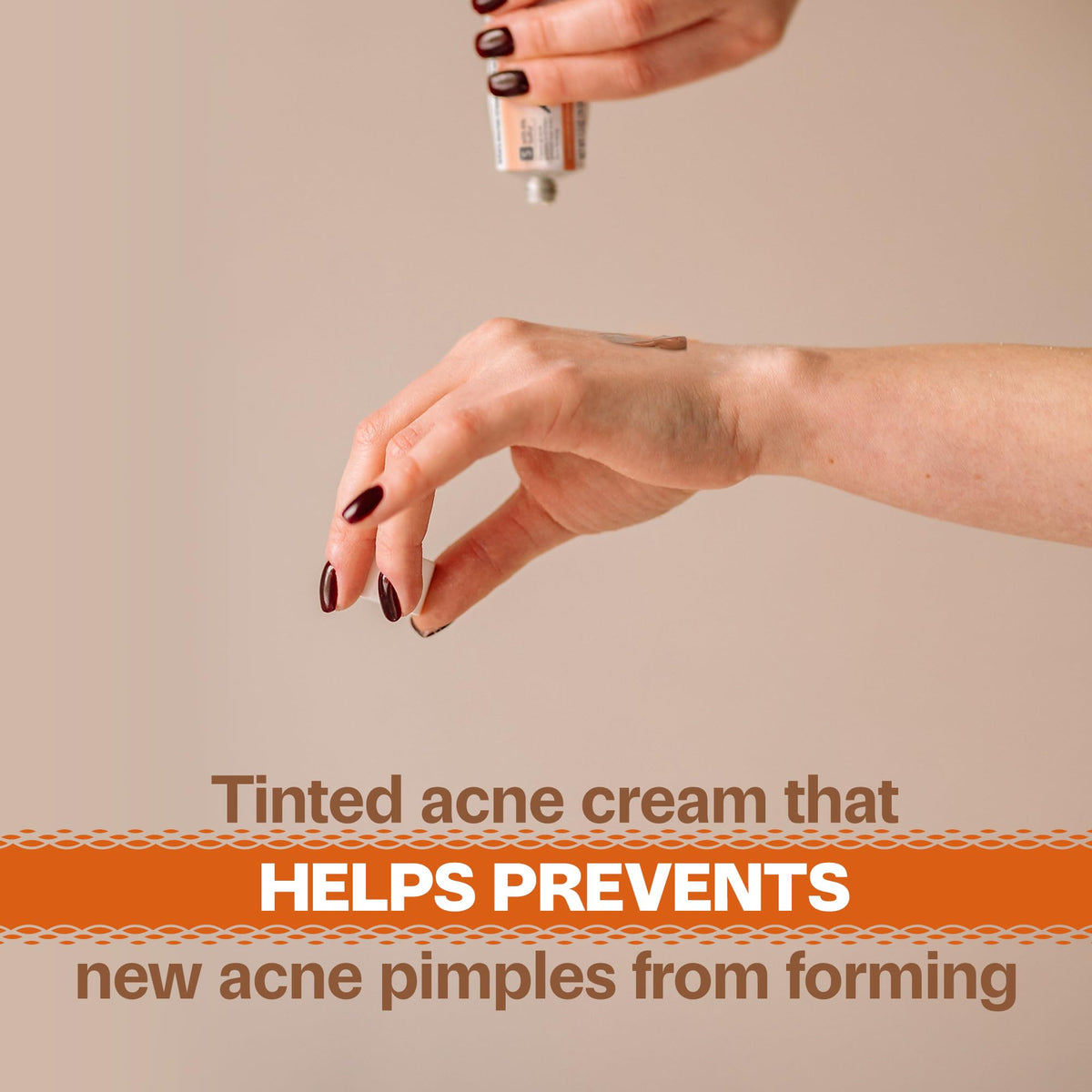 Adult Acnomel open cap displaying cream texture and non-greasy finish benefit