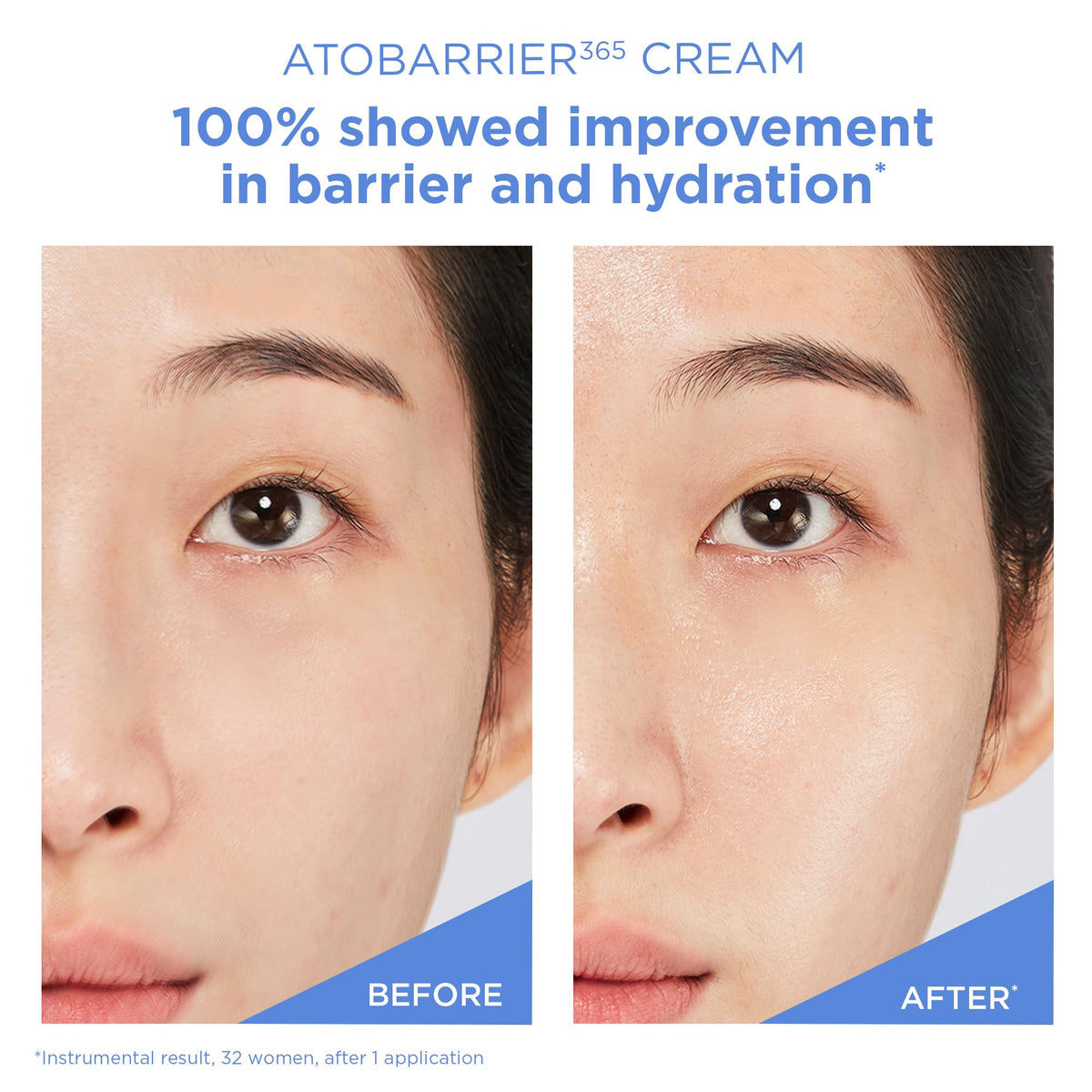 AESTURA cream in a clinical setting after microneedling for gentle post-care support