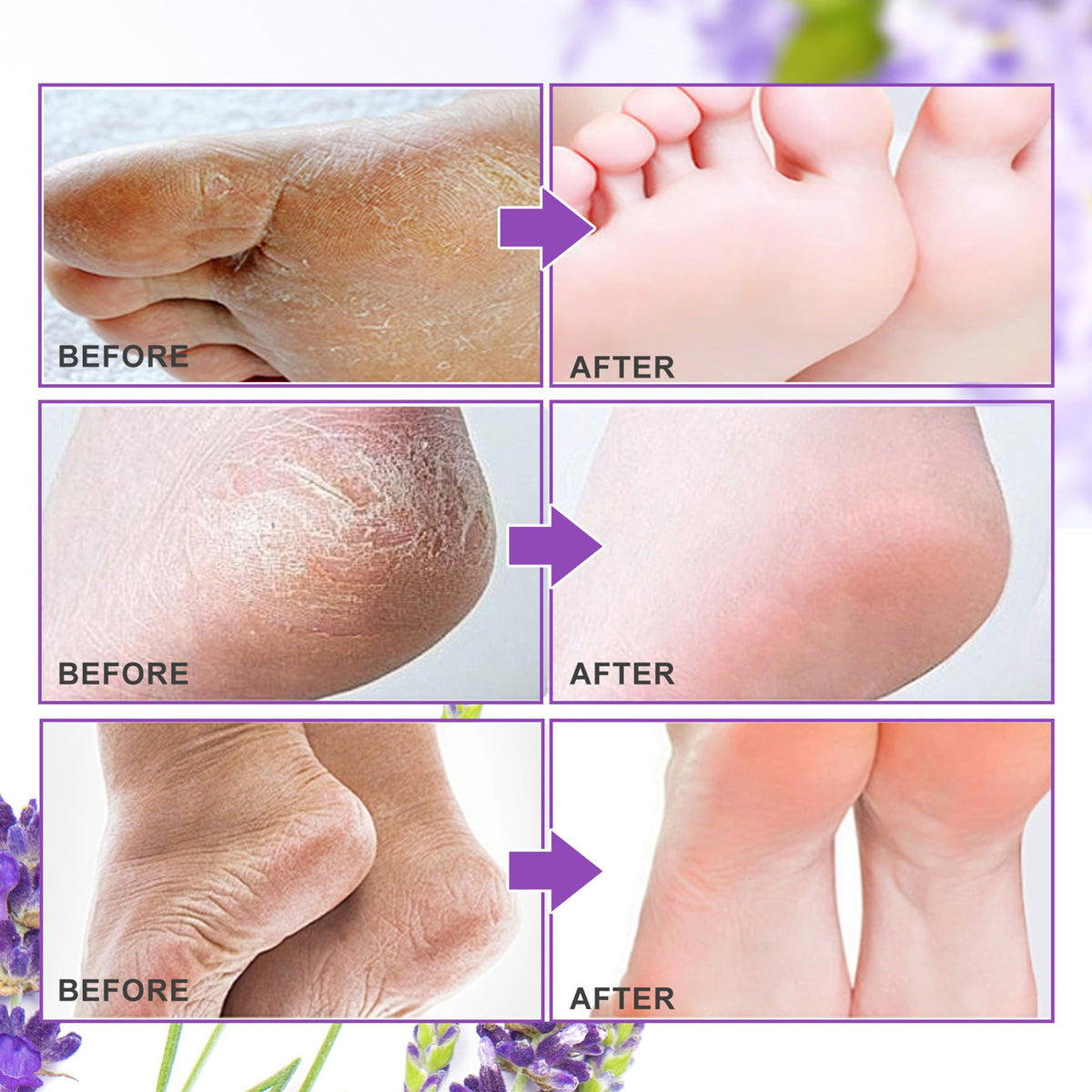 ALIVER before and after feet comparison showing reduced calluses and smoother skin