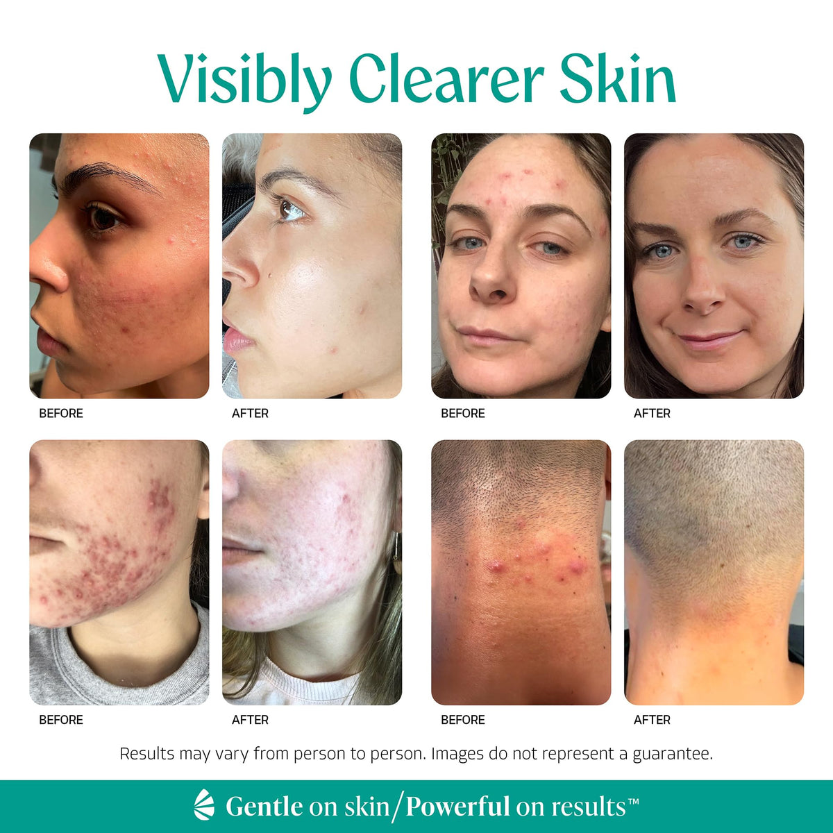 Almond Clear ingredient label highlighting mandelic acid and gentle formula benefit