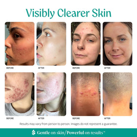 Almond Clear ingredient label highlighting mandelic acid and gentle formula benefit