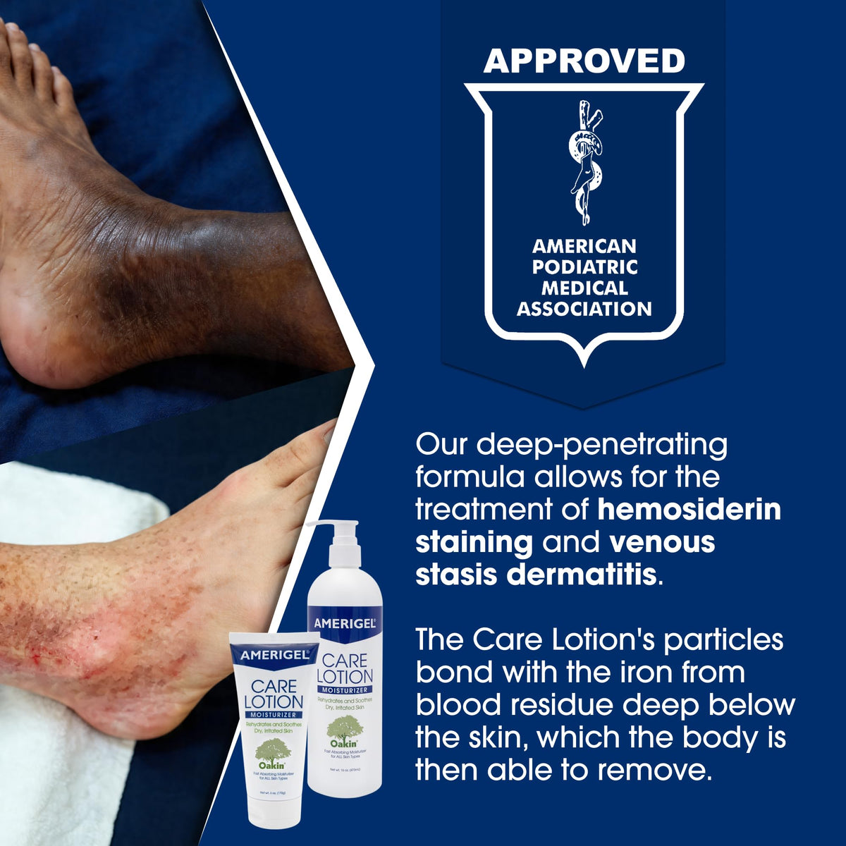 AMERIGEL Care Lotion applied to heel demonstrating soothing, targeted hydration