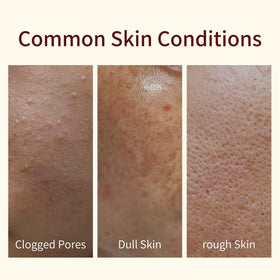 AOPEIBOTO applied on model's face illustrating gentle exfoliation and soothing comfort