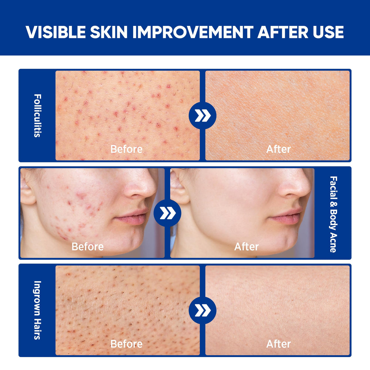 AOSORW dabbed on facial spot highlighting focused acne and redness soothing