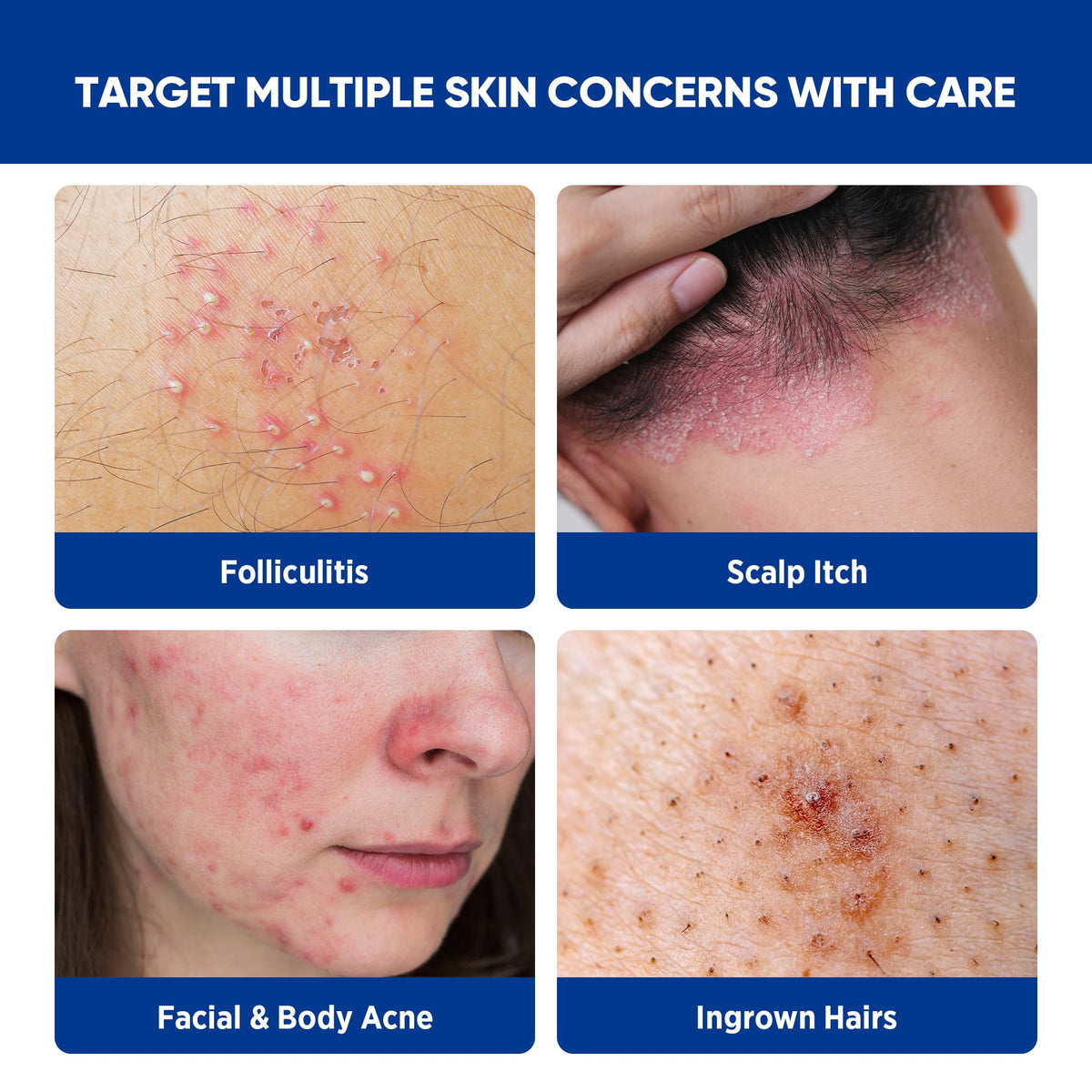 AOSORW applied to scalp area demonstrating targeted folliculitis relief use