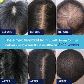 Applying Artimore foam to scalp to support targeted coverage and absorption