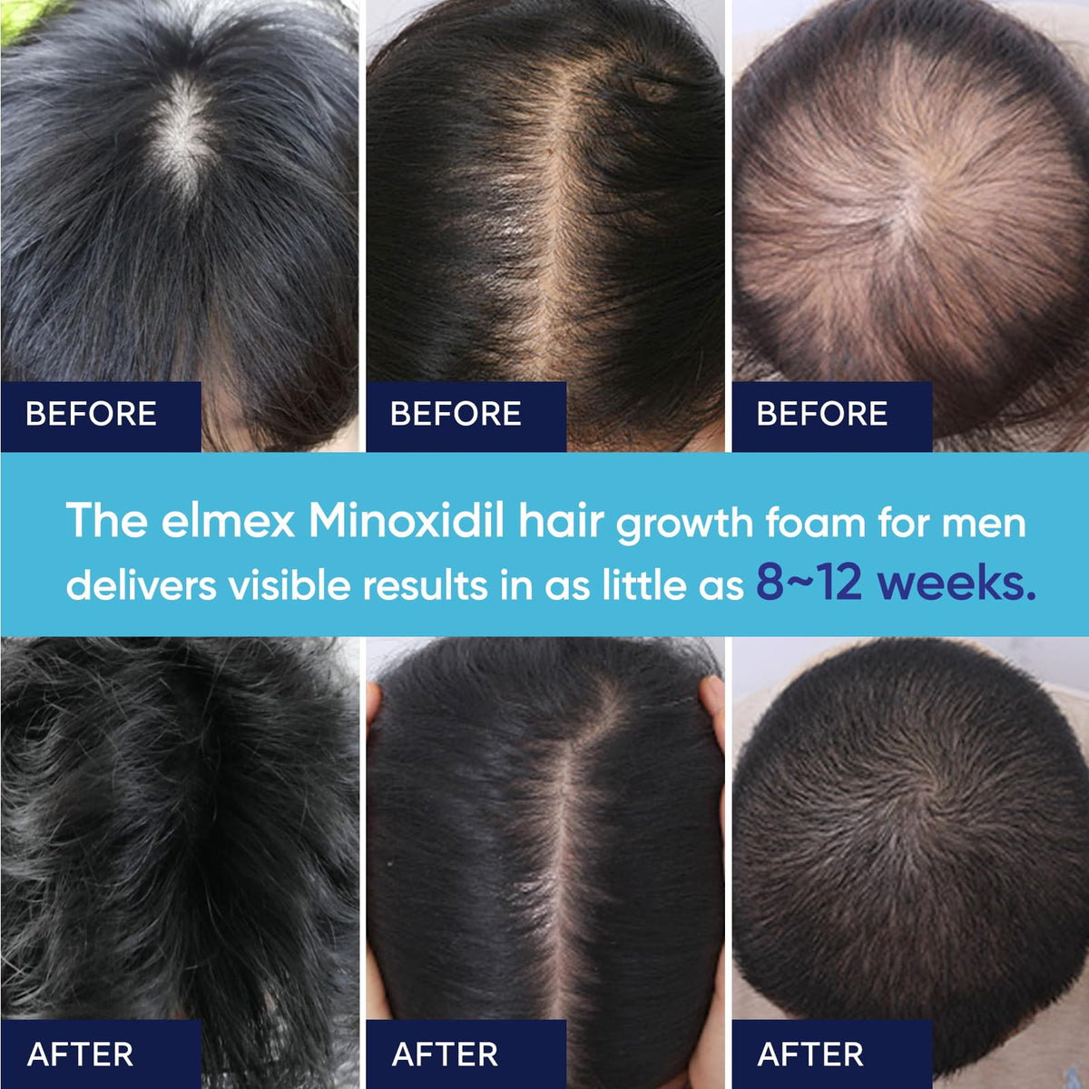 Artimore ingredients label detail showing minoxidil and nourishing additives for stronger hair