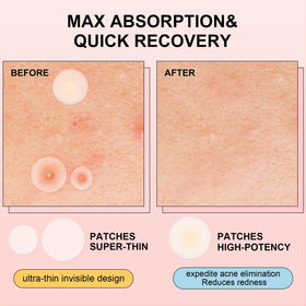 AVJONE hydrocolloid texture detail showing absorbent layer benefit