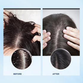 Bablabear being applied to wet scalp in hand to remove buildup