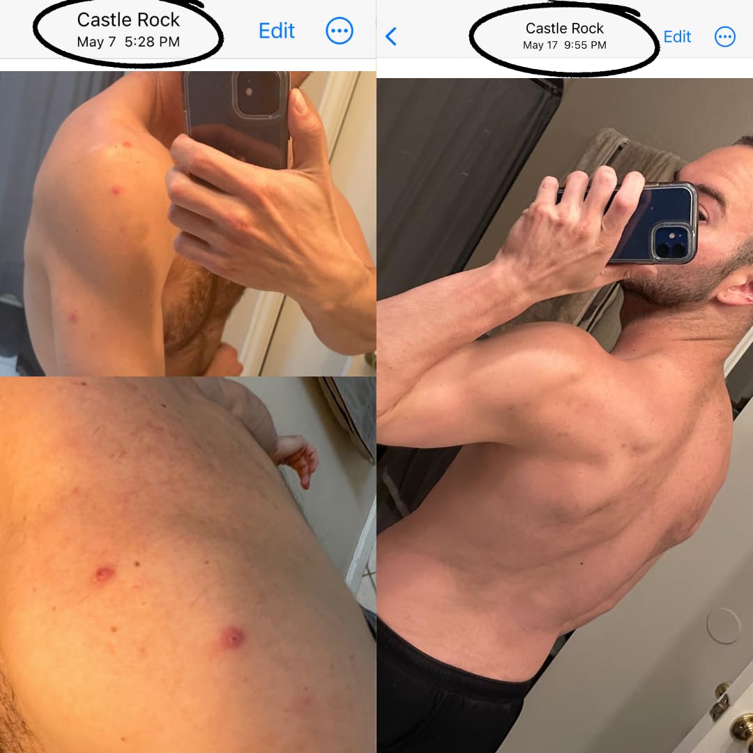 Bacne Bar applied after shower showing smoother, refreshed body skin