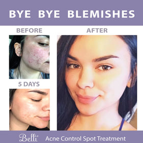 Belli spot treatment applied during skincare routine demonstrating targeted overnight use