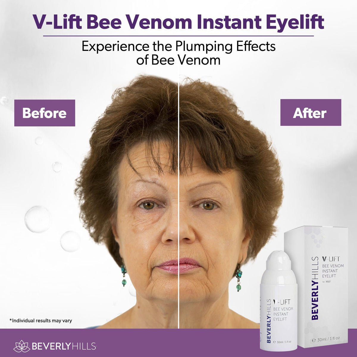 BEVERLY HILLS before and after eye area comparison showing reduced puffiness