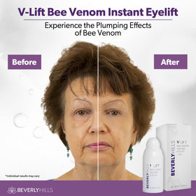 BEVERLY HILLS before and after eye area comparison showing reduced puffiness