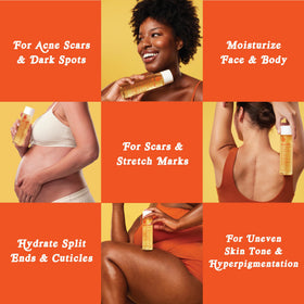 Bio-Oil being massaged onto belly, shows support for stretch mark hydration