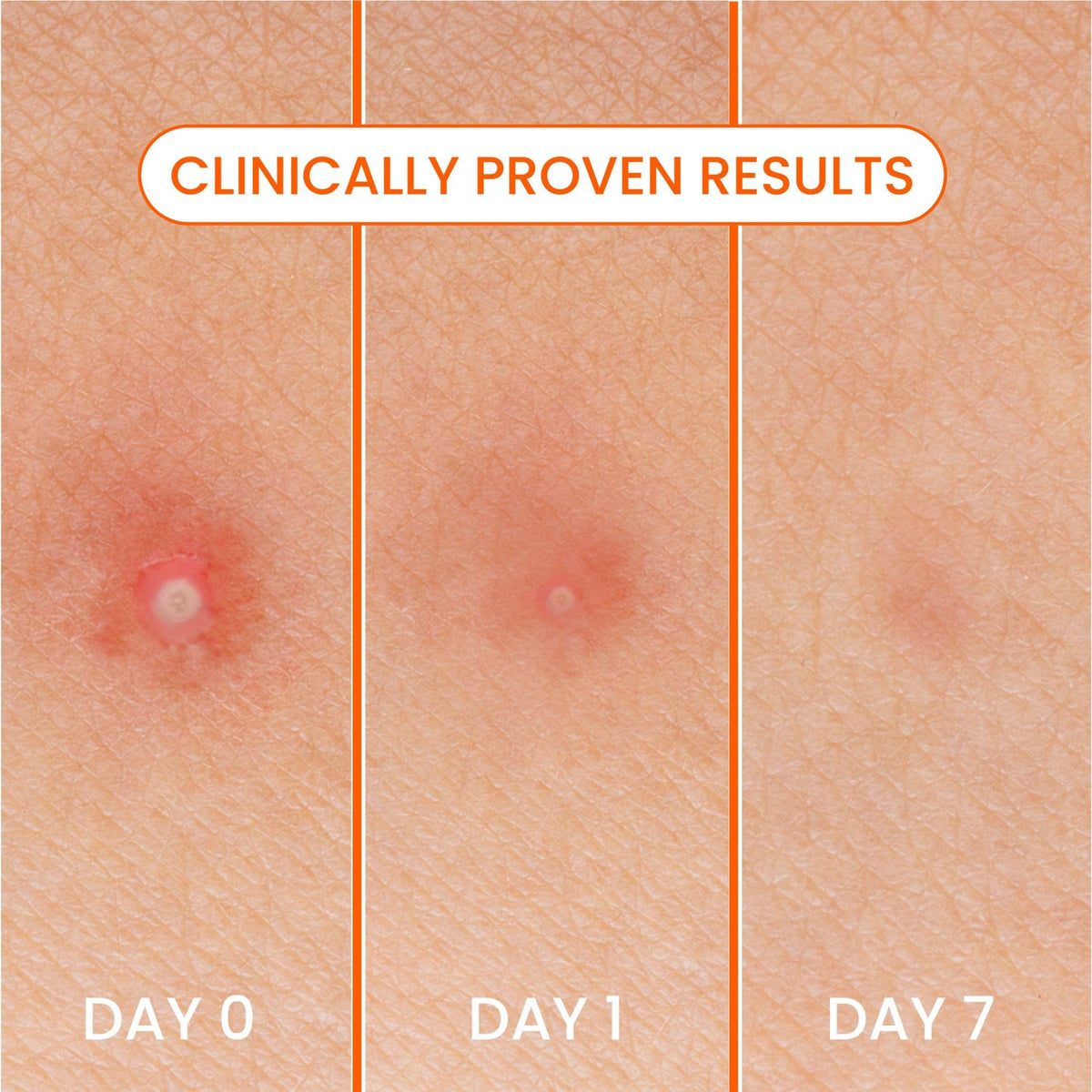 Biore patch applied on cheek protecting blemish with discreet look
