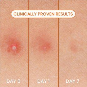 Biore patch applied on cheek protecting blemish with discreet look