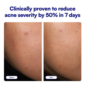 Bliss tube tip dispensing small dot, demonstrates easy targeted application benefit