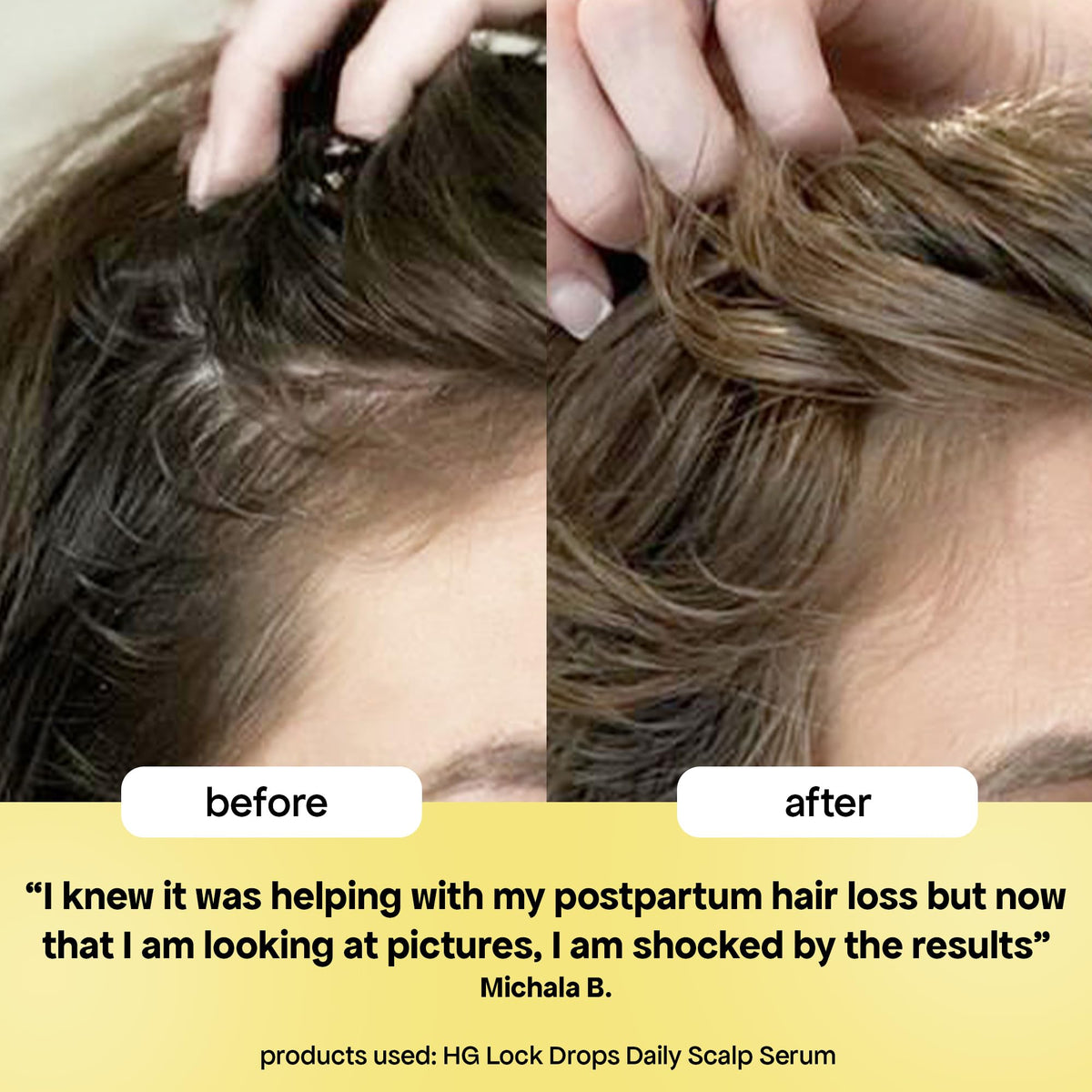BondiBoost before and after hairline comparison showing improved density