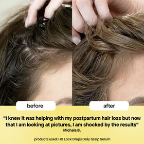 BondiBoost before and after hairline comparison showing improved density