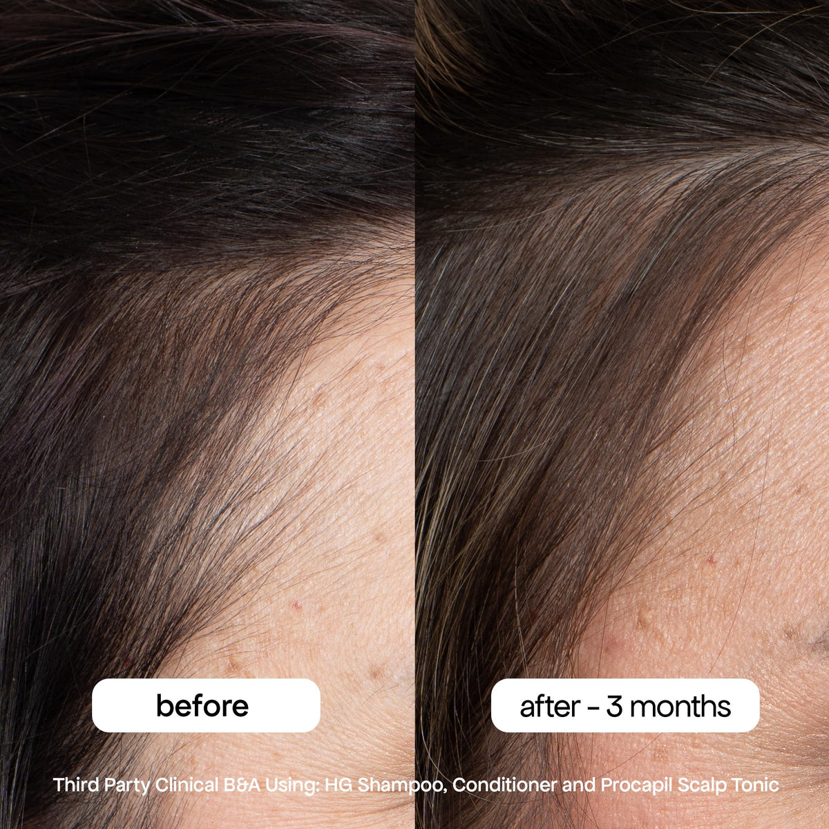 BondiBoost botanical ingredients rosemary and saw palmetto supporting scalp health