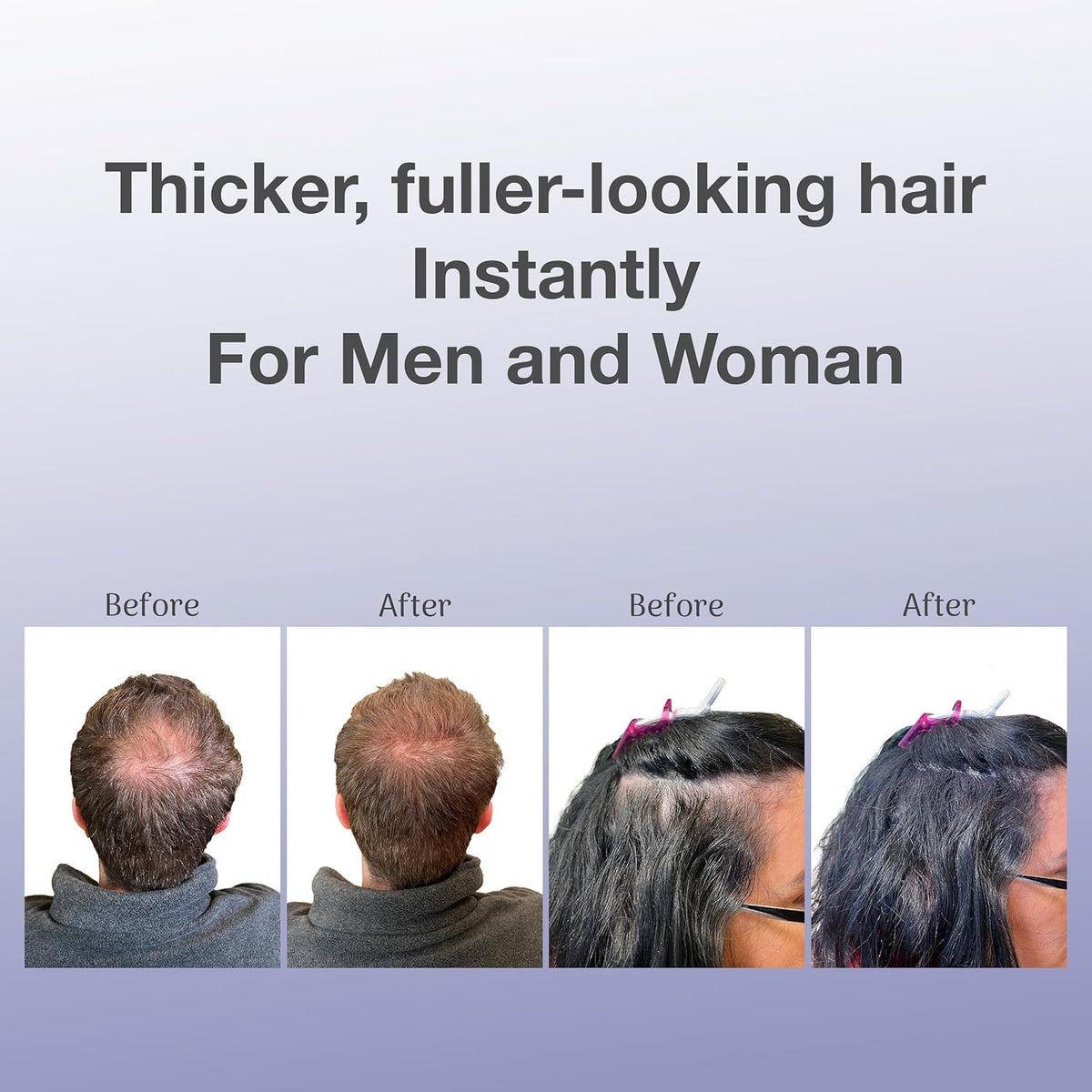 BosleyMD before and after comparison demonstrating fuller, thicker appearance