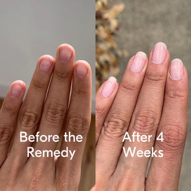 Botanist The Remedy before and after nails demonstrating repaired, less-ridged nails