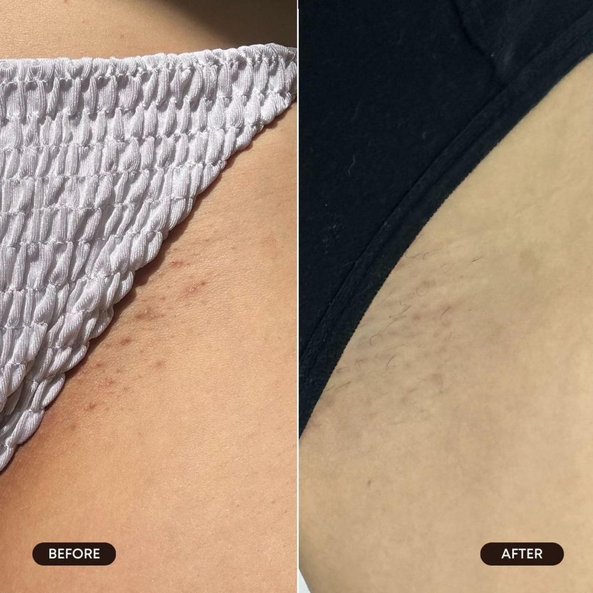 Bushbalm bikini-area application showing targeted use and comfort