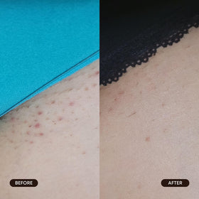 Bushbalm pad used on bikini line to soothe razor bumps