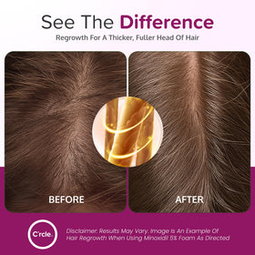 C'rcle being applied to scalp demonstrating targeted thinning area support