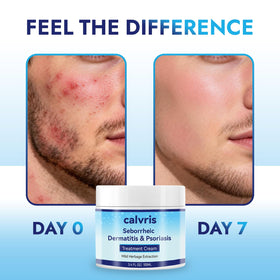 Calvris balm being massaged into scalp for cooling relief