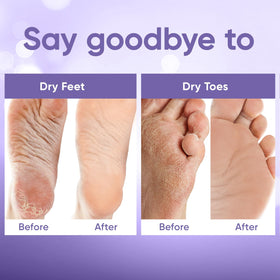 CÉLOR before and after feet comparison, illustrating smoother, softer skin result