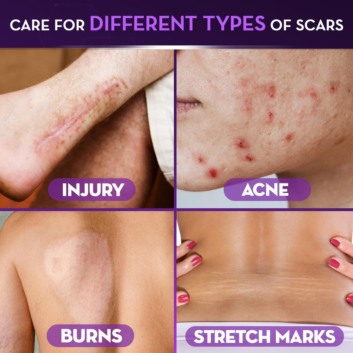 Cicatricure being applied to a healed scar for visible smoothing benefit
