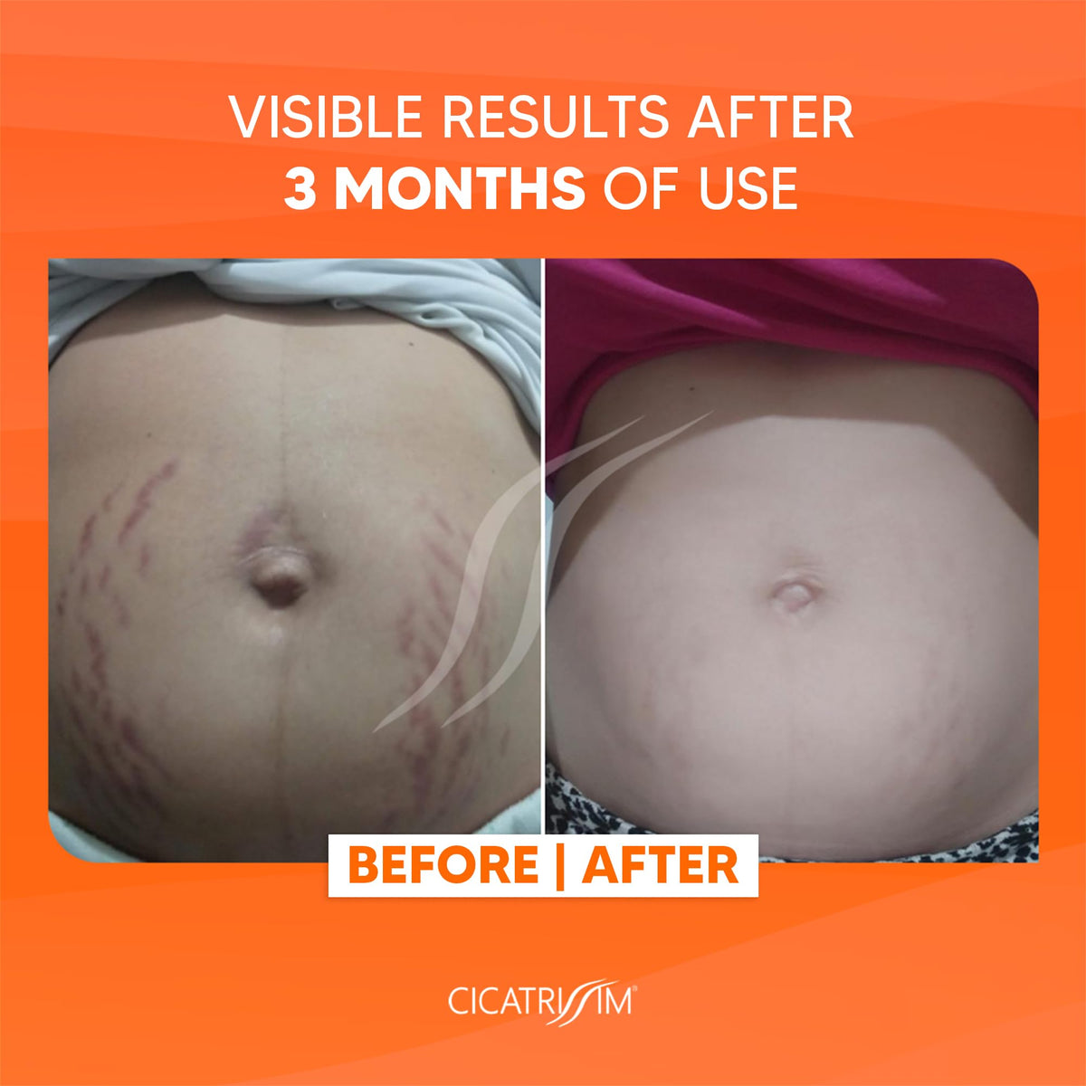Cicatrissim being massaged on abdomen to soften stretch marks