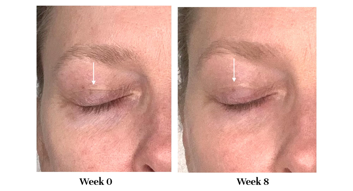 City Beauty before and after comparison showing lifted eyelid appearance