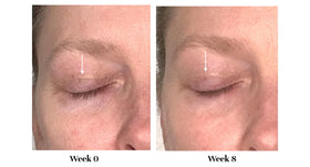 City Beauty before and after comparison showing lifted eyelid appearance