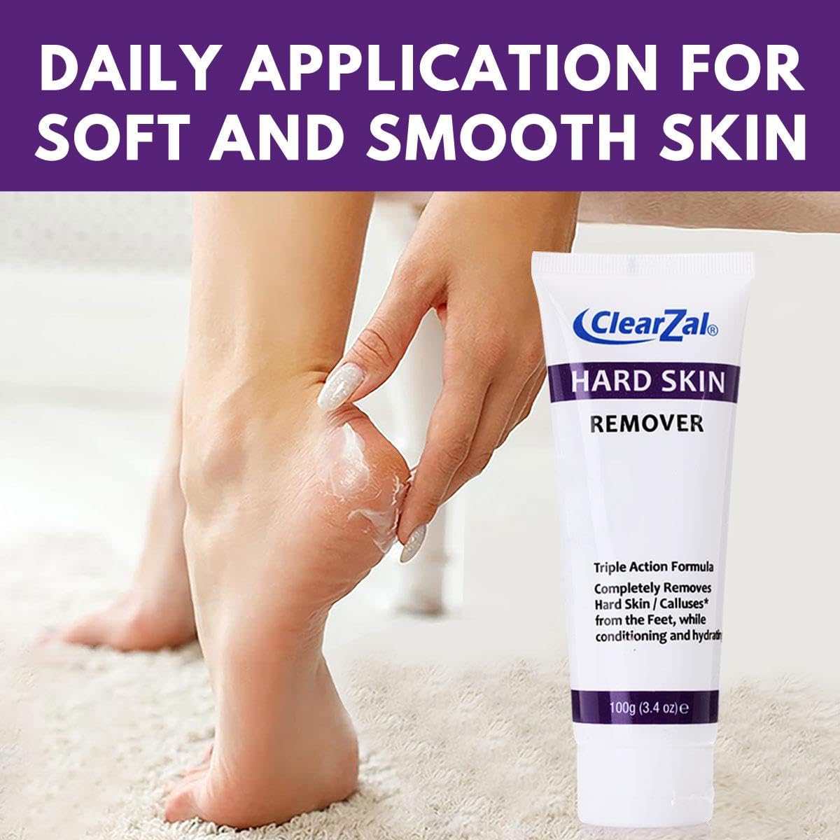 Clearzal being applied to heel, shows targeted treatment for calluses