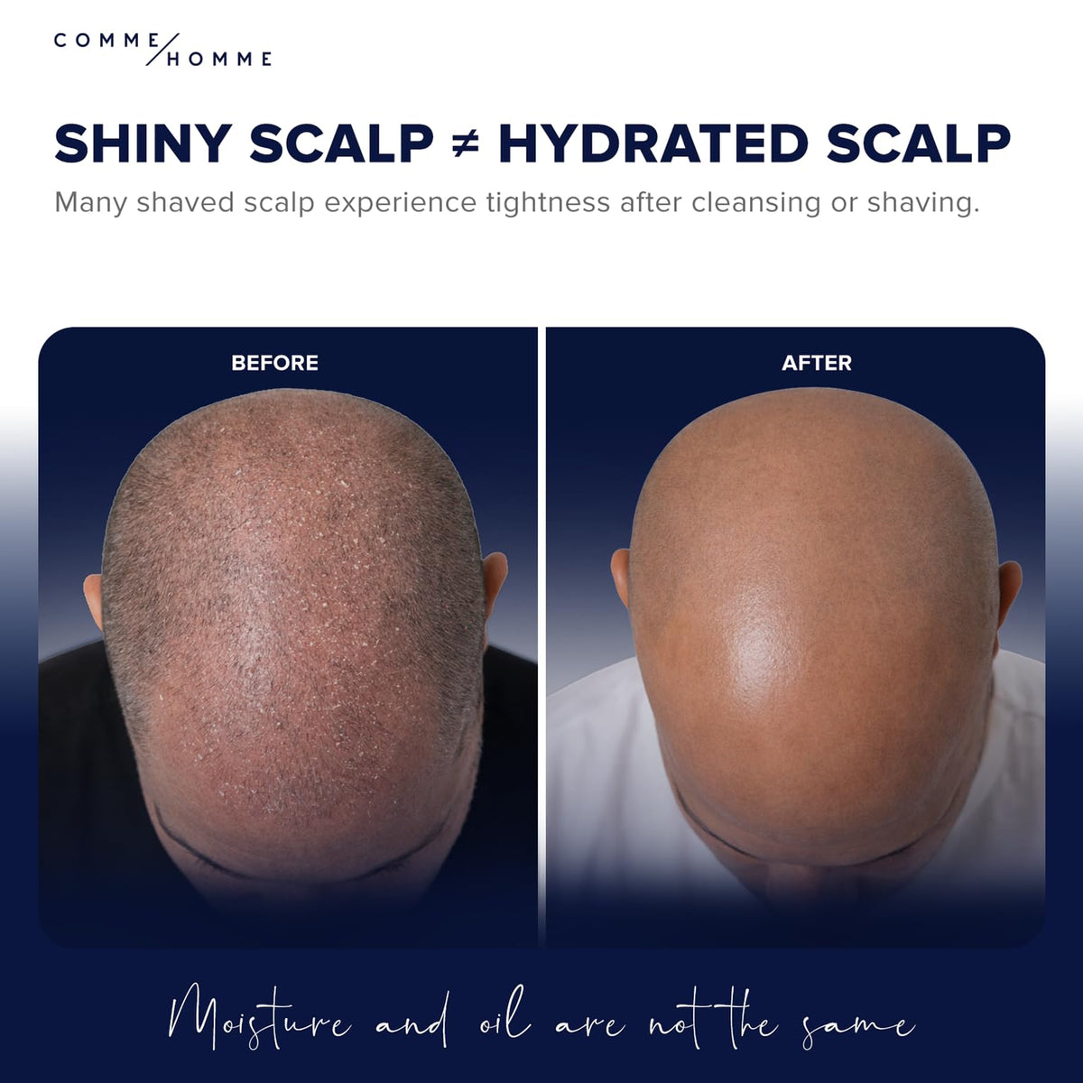 Comme Homme applying moisturizer to bald scalp for immediate soothing benefit