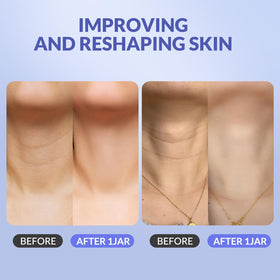 Crogooe neck before and after visual showing improved skin texture