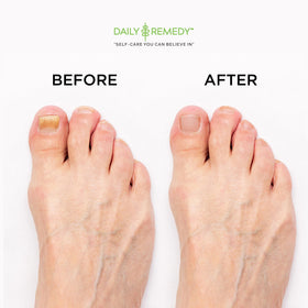 Daily Remedy foot soak being used in a basin demonstrating soothing comfort