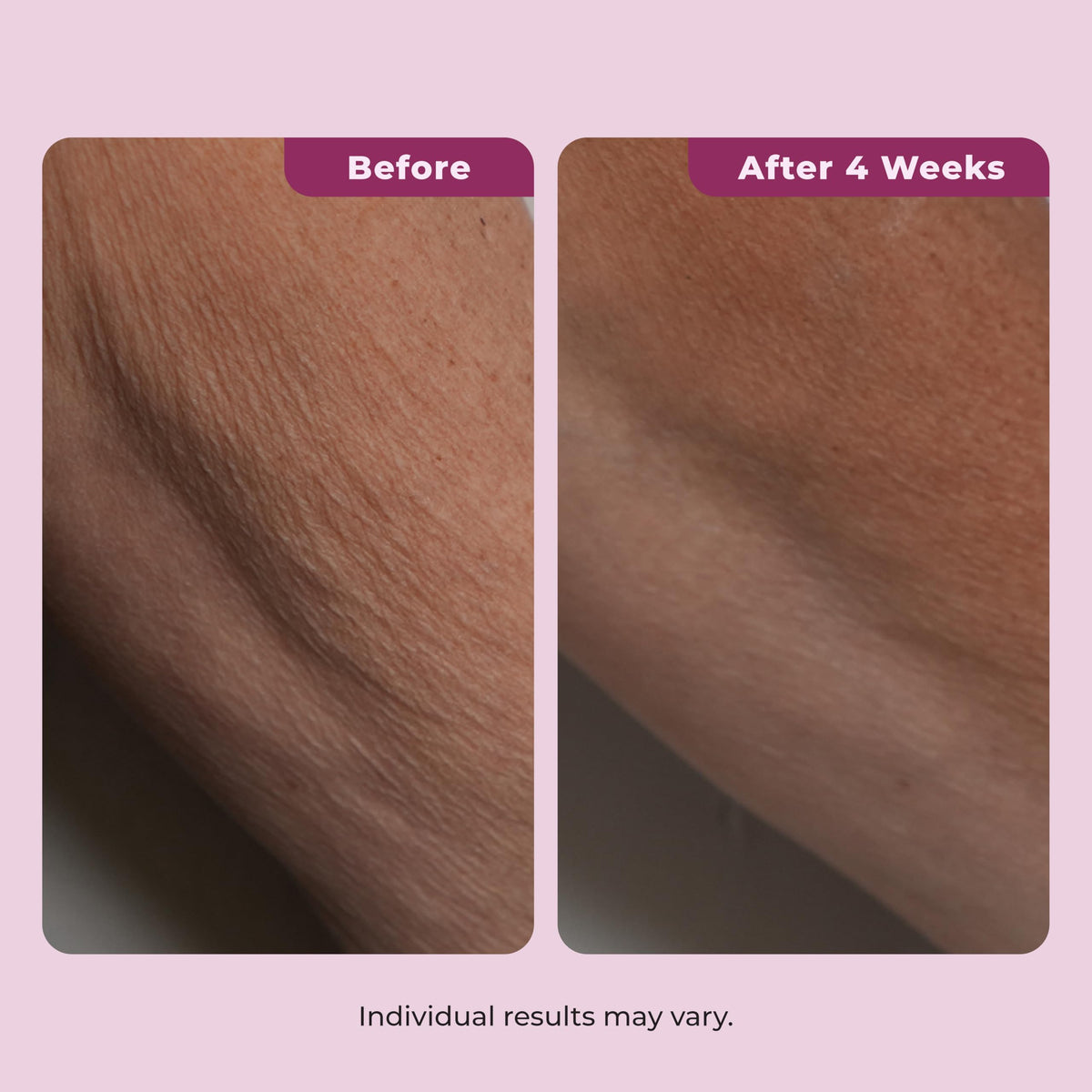 DEKLIDERM applied to neck showing immediate smooth finish