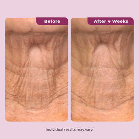 DEKLIDERM used on chest in lifestyle scene for hydrated décolleté