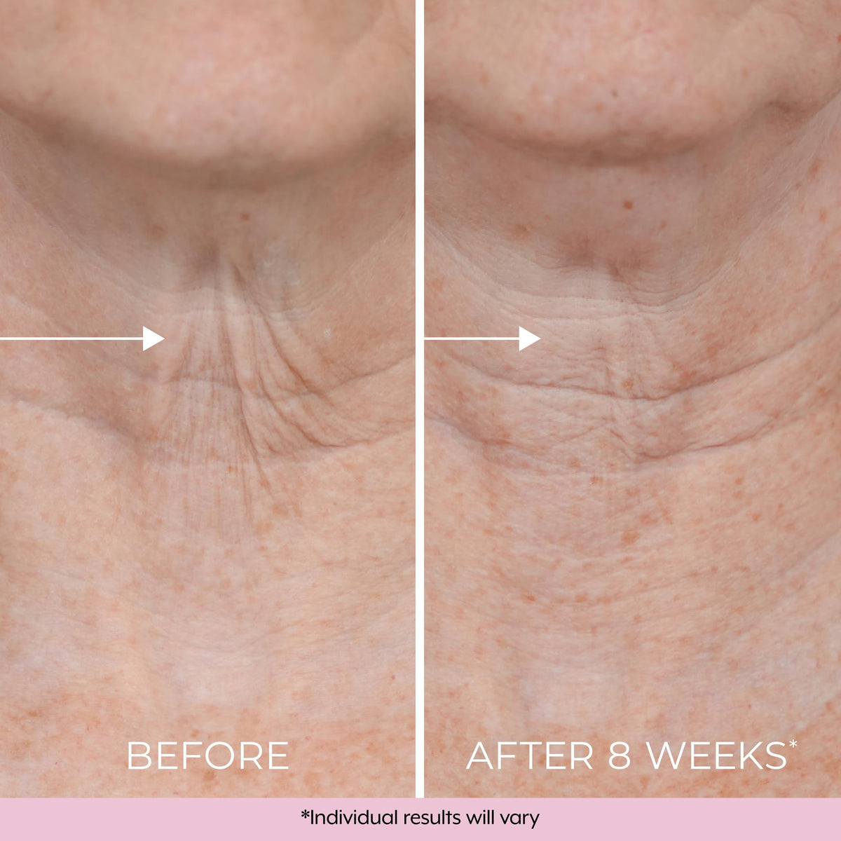 DEKLIDERM upper arm before and after effect for firmer appearance