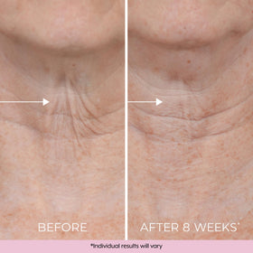 DEKLIDERM upper arm before and after effect for firmer appearance